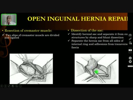 Open Inguinal Hernia Repair - Operative Surgery