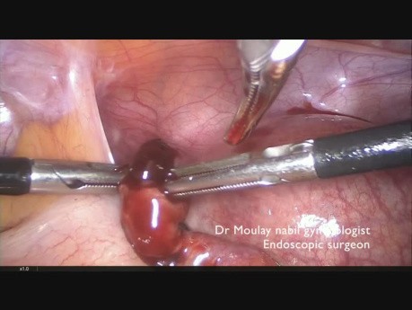 Laparoscopic Conservative Treatment for Ectopic Pregnancy