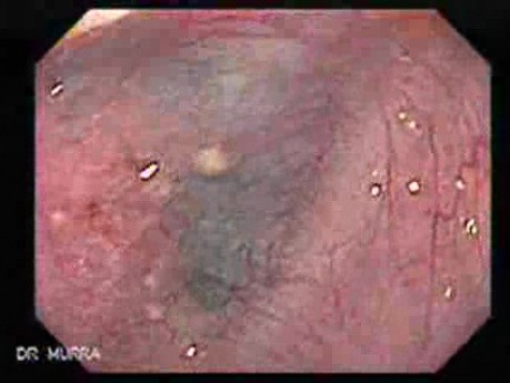 Esophageal Diverticula - Searching for the Diverticulas