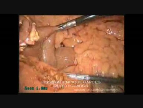 Whipple Laparoscopy