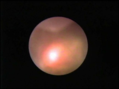 Ureterolithotripsy