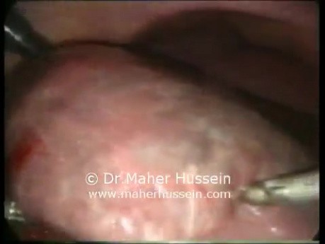 Segment Liver resection - Laparoscopic Approach