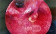 Pedunculated Aryepiglottic Cyst