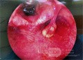 Pedunculated Aryepiglottic Cyst