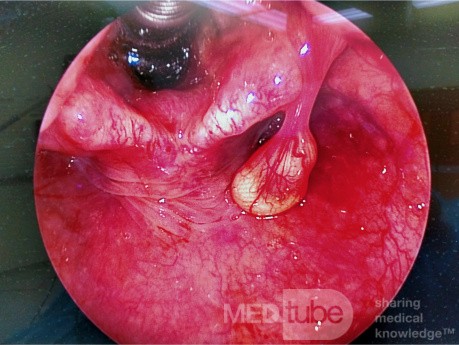 Pedunculated Aryepiglottic Cyst