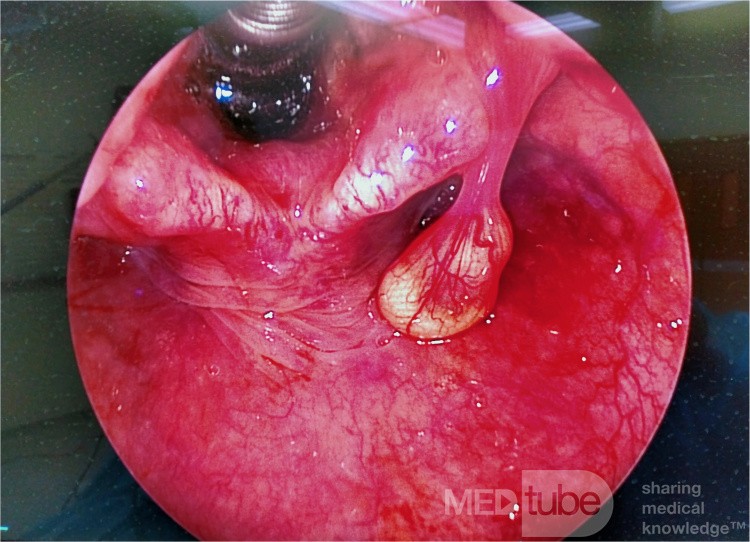 Pedunculated Aryepiglottic Cyst
