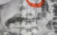 Missed Tip of GW, After Percautenouse Renal Cyst Aspiration