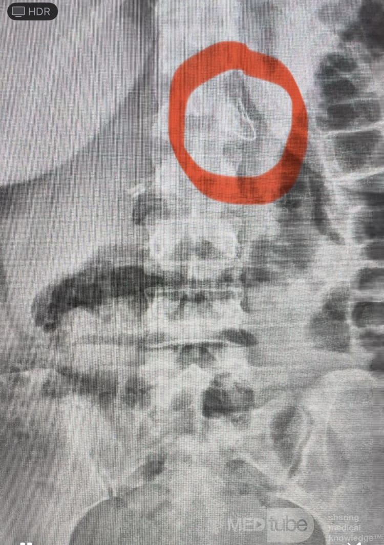 Missed Tip of GW, After Percautenouse Renal Cyst Aspiration