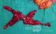 Thoracoscopic Thymectomy