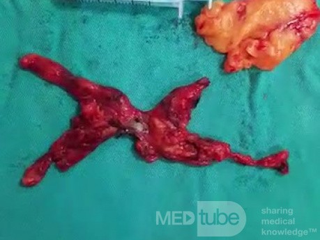 Thoracoscopic Thymectomy
