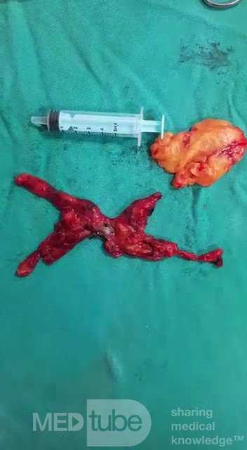 Thoracoscopic Thymectomy