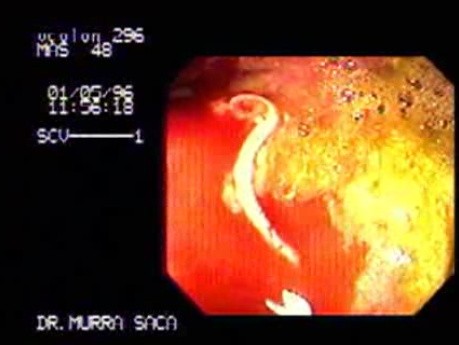 Trichuris Trichiura (whipworm) (1 of 2)