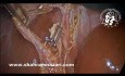  Acute Cholecystitis Makes Laparoscopic Cholecystectomy Easier