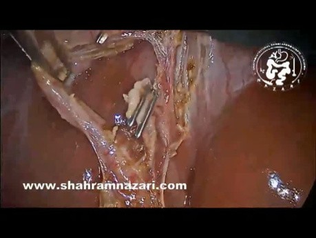  Acute Cholecystitis Makes Laparoscopic Cholecystectomy Easier