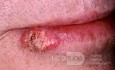 Squamous Cell Carcinoma of the Lip