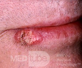 Squamous Cell Carcinoma of the Lip