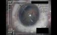 Cataract Surgery VI - Part 1