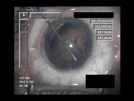 Cataract Surgery VI - Part 1