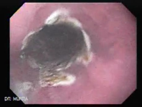 Barrett's Esophagus of long segment (9 of 11)
