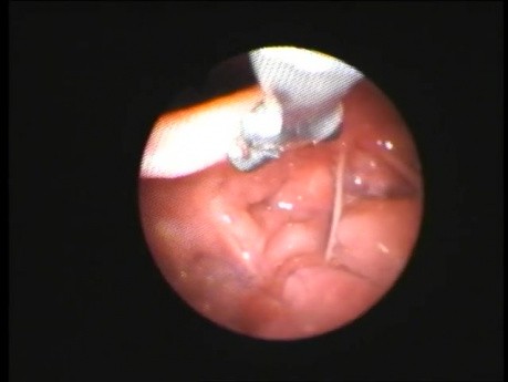 Fishbone Removal - Transnasal Fiberoptic Approach