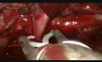 Avoiding Pneumonectomy Single Port VATS Vascular Control of a Huge Tumor