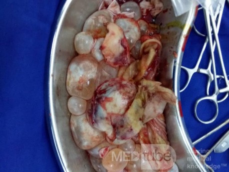 Multiple Daughter Cyst Removed From The Liver