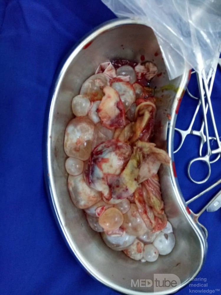 Multiple Daughter Cyst Removed From The Liver
