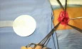 Umbilical Hernia Repair Video