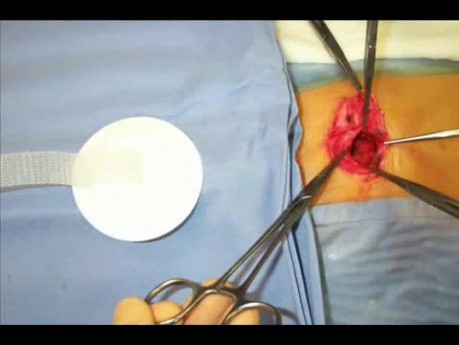 Umbilical Hernia Repair Video