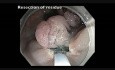 Colonoscopy Channel - EMR Of A Giant Rectal Polyp