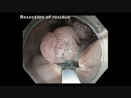 Colonoscopy Channel - EMR Of A Giant Rectal Polyp