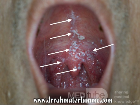 Oral Thrush