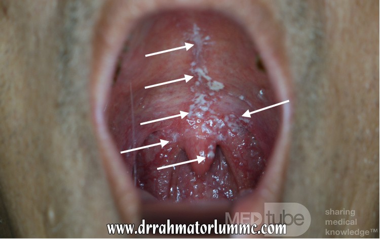 Oral Thrush