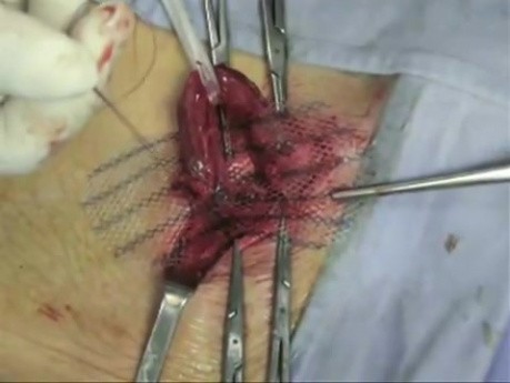 Indirect hernia repair