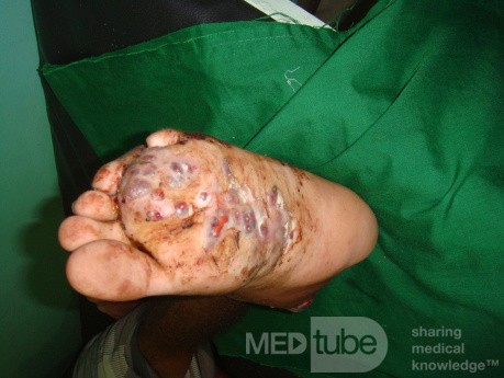 Mycetoma in the left foot