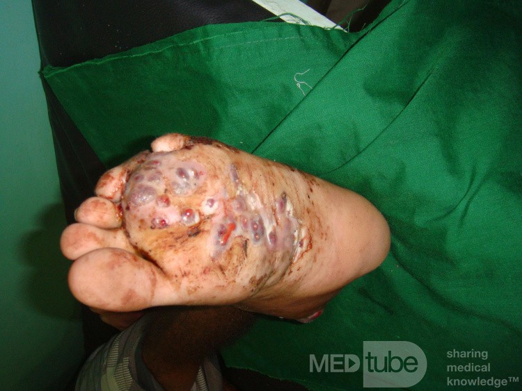 Mycetoma in the left foot