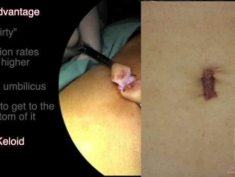 Different Techniques of Insertion of the First Trocar