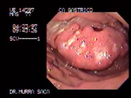 Adenocarcinoma of the Antrum