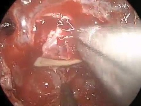 Lymphocytic Hyphophysitis - Autoimmune Disorder