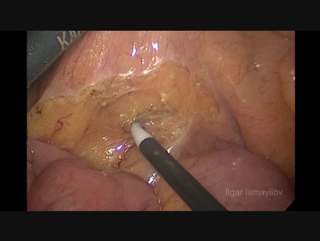 Laparoscopic Left HemyColectomy Complete Mesocolic Exsision for Sigmoid Colon Carcinoma