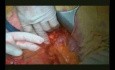 Right Open Hemicolectomy – Technical Principles - Part 2