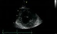 Parasternal Sternal Axis View At The Level Of Apex - Normal Study