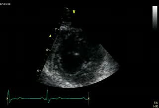 Parasternal Sternal Axis View At The Level Of Apex - Normal Study