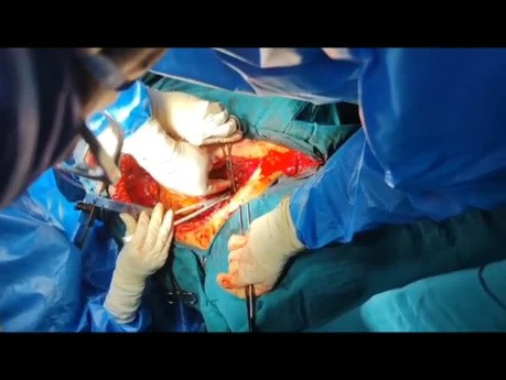 How to Manage Zone 1 Neck Injuries With Great Vessels Trauma Regarding Brain Protection Facilities Intraoperatively 