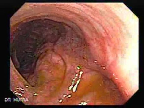 Consecutive colonoscopy with dilation was carried out (15 of 15)