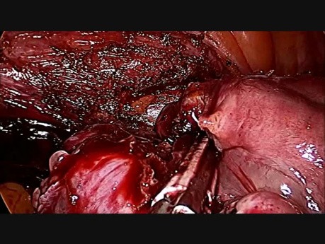 Unedited Total Laparoscopic Hysterectomy 