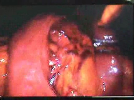 Jejunal Gastrointestinal Stromal tumor (GIST) (26 of 86)