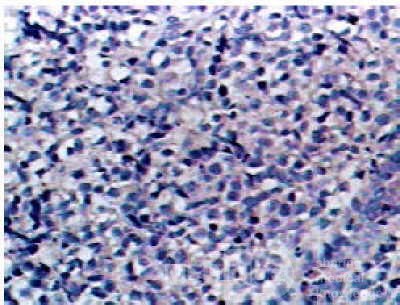 Non-Hodgkin's Lymphoma of the Colon (16 of 16)