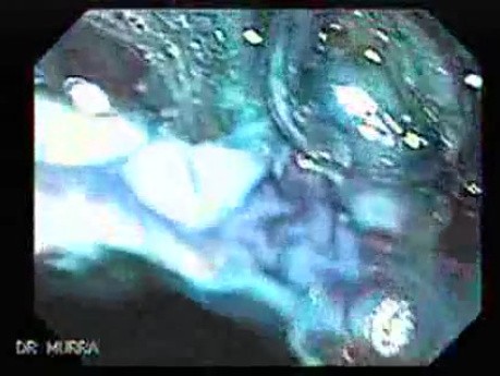 Barrett's Esophagus of long segment (14 of 24)