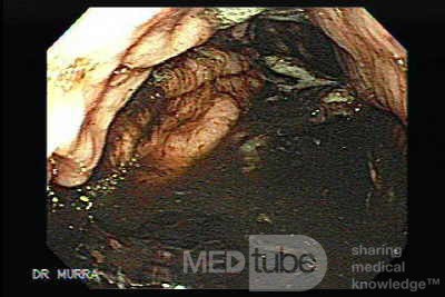 Gastric Cancer - 84 Years-Old Male
